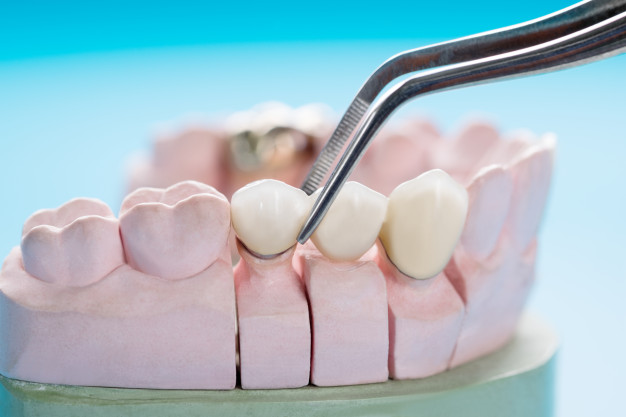Just as in architecture, a bridge spans the distance between two supports, in dentistry, a bridge spans the space created by a missing tooth or teeth and is secured by crowns attached to carefully prepared natural teeth on either side of the space.
