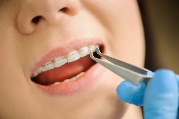 Orthodontic treatment includes the use of dental braces and orthodontic appliances to move the teeth and jaw so they can align into an ideal relationship. Jaw surgery may be required in very severe cases.