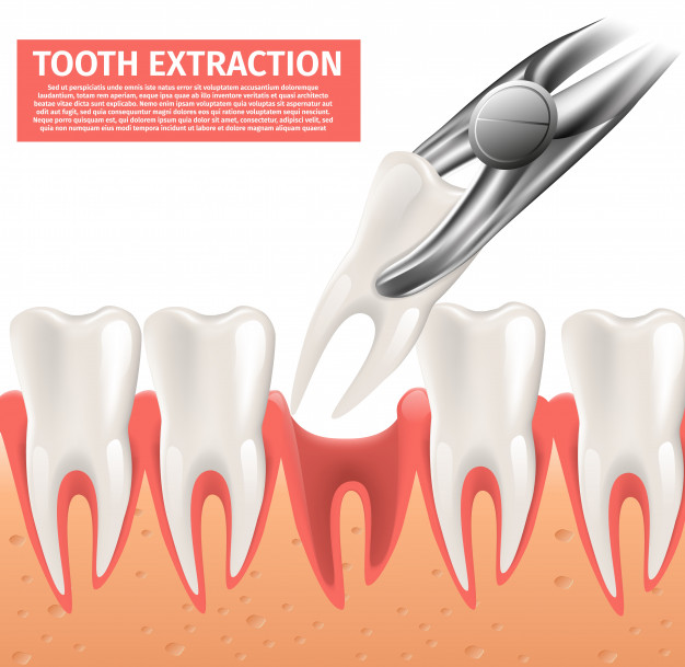 Dental Extraction