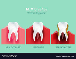 Gum Disease