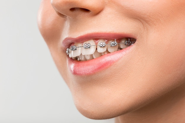 Orthodontic treatment is usually of 18-30 months duration. However, it can vary depending on the severity of the malocclusion and patient cooperation. At the end of the treatment, retainers are required to hold the teeth in place.
