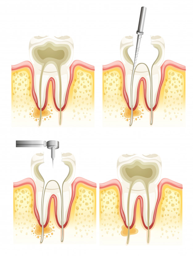 Root Canal Treatment